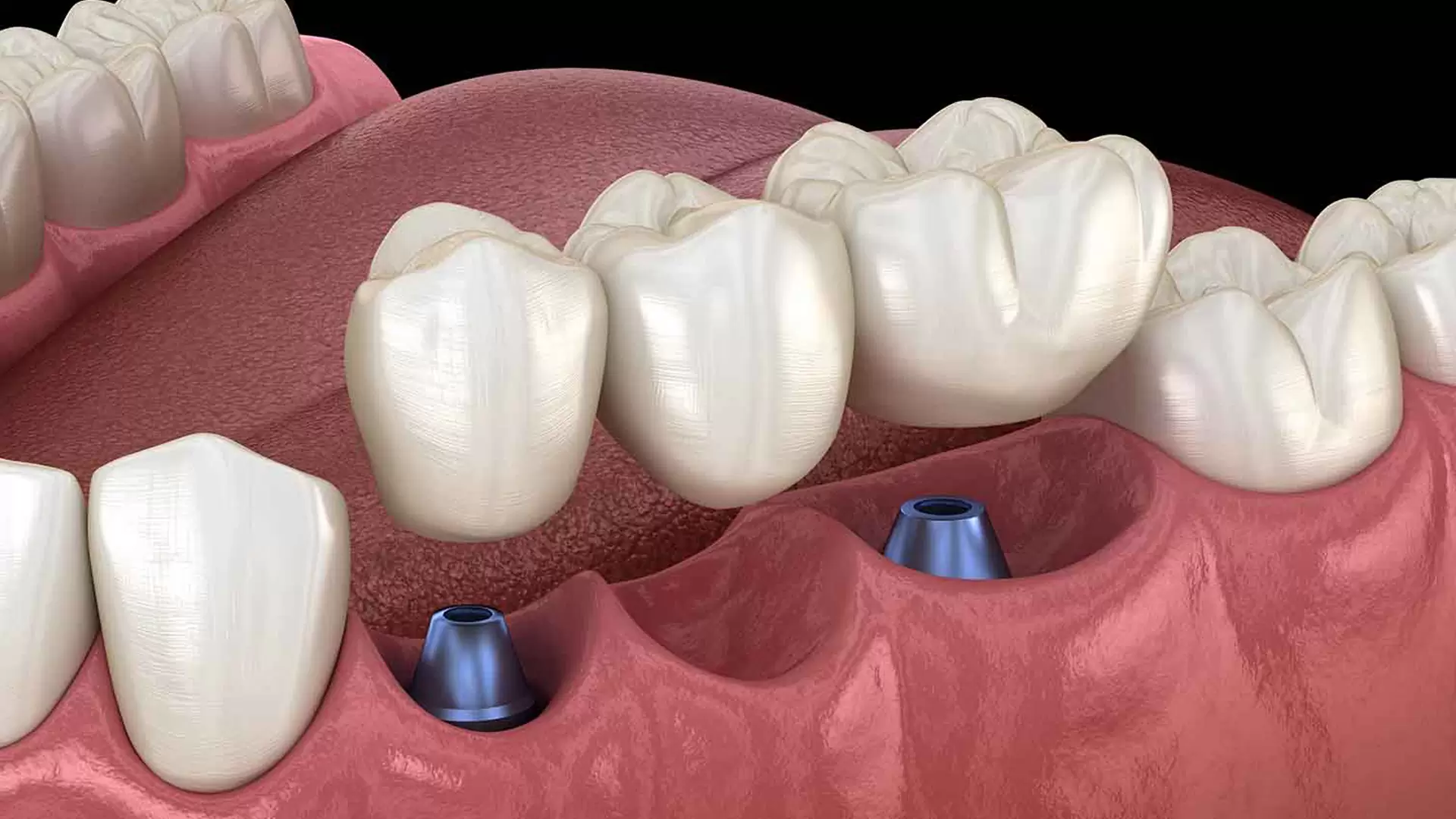 What Does Pain Around Dental Bridges Indicate?