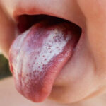 Oral Thrush
